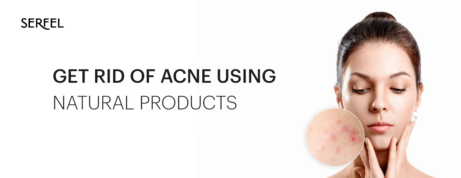 Get Rid of Acne Pores Using Natural Products